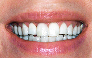 dental-implant-after